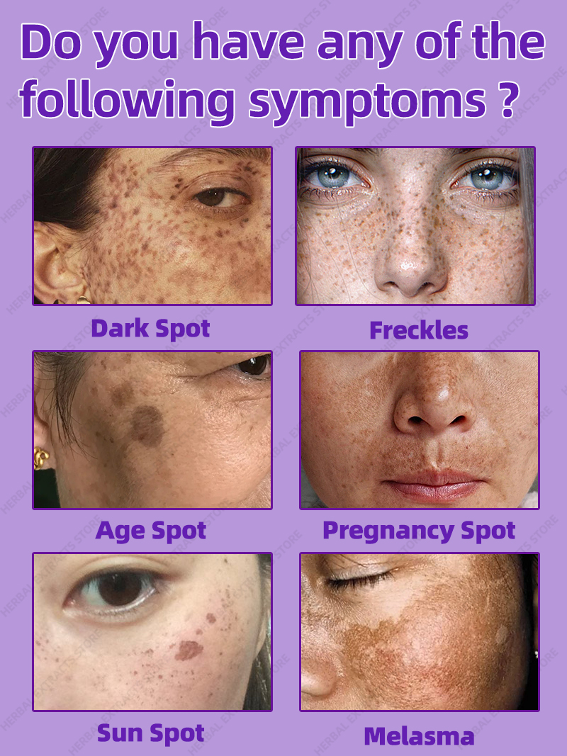 Best of Freckles Removal Melasma Cream Dark Spot Remover For Face Reviews & Tips - Image 3