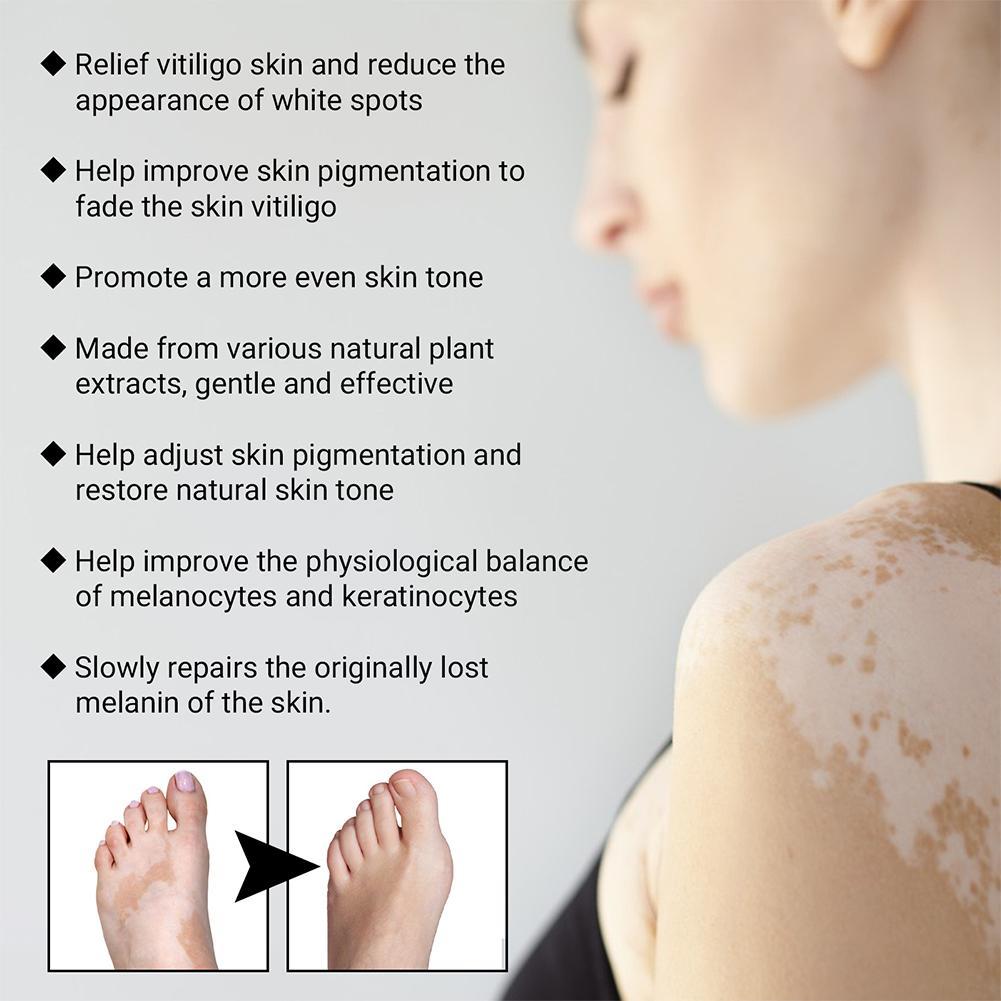 Best of 30ml Vitiligo Relief Spray Skin Moisturizing Vitiligo White Face Spray Net Repair Spot Fades Spots Vitiligo Body Repair Ski E5X2 Reviews & Tips - Image 4