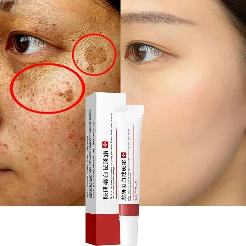 Best of Skin Face Whitening Freckle Cream Remove Melasma Acne Pigment Melanin Dark Spots Anti Freckle Cream Fade Pigmentation Brighten Reviews & Tips