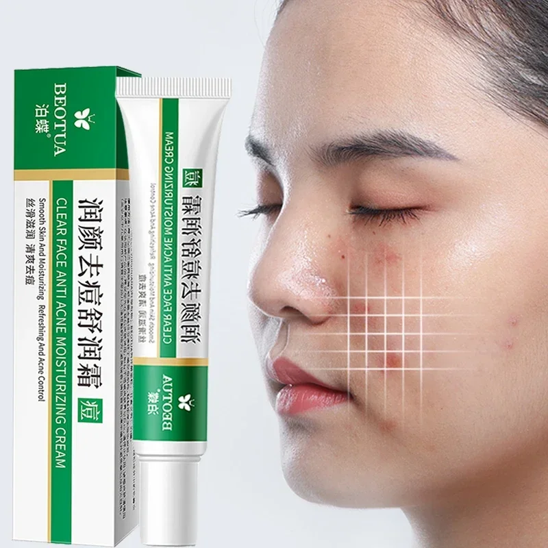 Best of Effective Acne Removal Cream Aloe Acne Spots Oil Control Anti-aging Moisturizing Whitening Acne Cream Treatment Skin Care 20g Reviews & Tips - Image 3