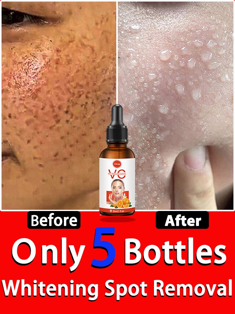 Best of Dark Spot Remover For Face Remove Black Chloasma Reviews & Tips