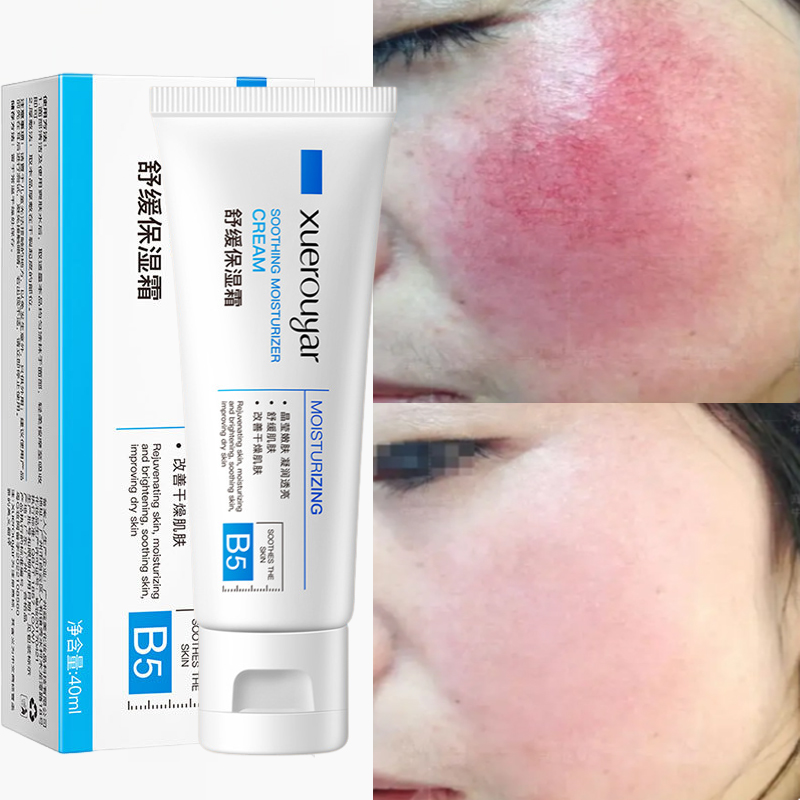 Best of Fast Facial Redness Repair Cream Soothes Repair Face Sensitive Skin Acne Removal Whitening Moisturing Skin Care Korean Cosmetics Reviews & Tips