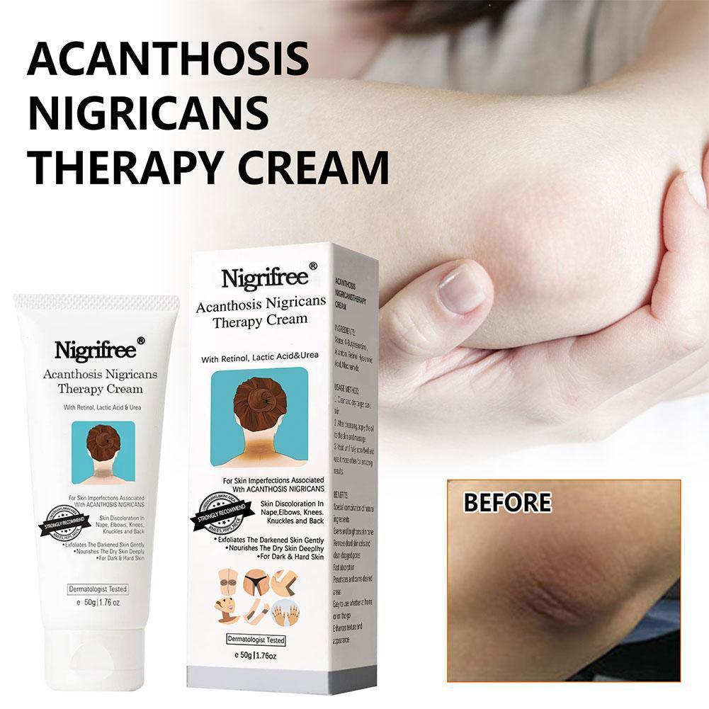 Best of Acanthosis Nigricans Therapy Cream Whitening Body Cream Removal Of Hyperpigmentation For Dark Body Parts Like Neck, Ankles W5G7 Reviews & Tips