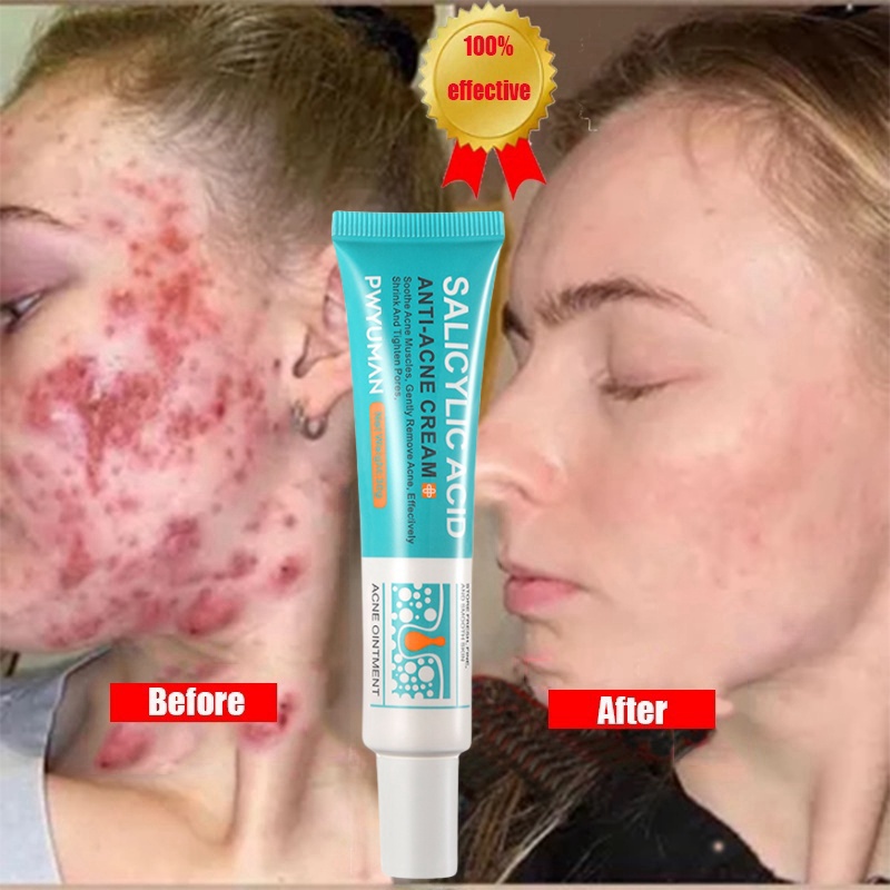 Best of 7 Days Acne Removal Cream Blackheads Salicylic Acid Treatment Cream Oil Control Pore Shrinkage Moisturizing Whitening Skin Care Reviews & Tips