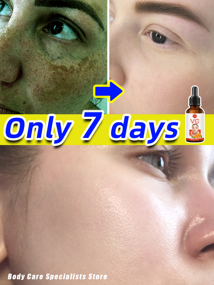 Best of Dark Spot Remover Melasma Chloasma Freckles Spot Removal Reviews & Tips