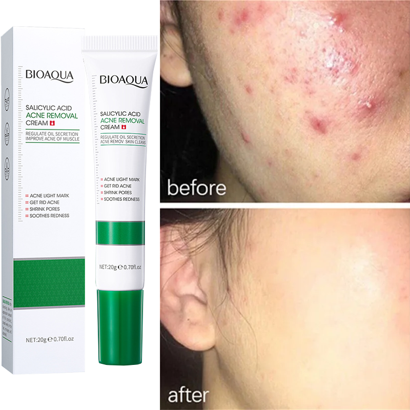 Best of Salicylic Acid Acne Removal Cream Effective Acne Treatment Remove Blackheads Acne Oil Control Shrink Pore Moisturizing Skin Care Reviews & Tips