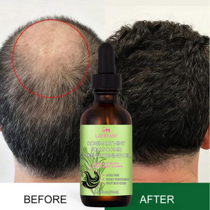 Best of Rosemary Mint Hair Growth Essential Oil Anti Hair Loss Strengthen Nourishing Treatment Split Ends And Dry Scalp Care Men Women Reviews & Tips