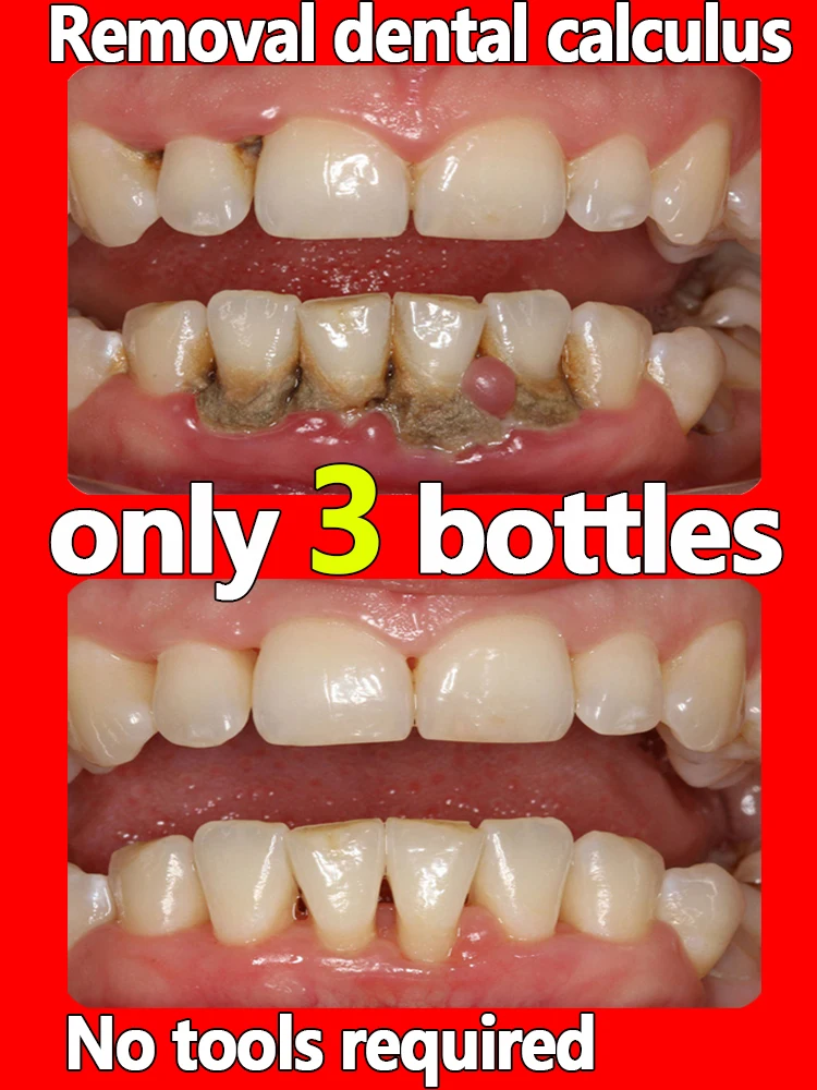 Best of Removal Dental Calculus Whitening Teeth Mouth Odour Removal Bad Breath Preventing Periodontitis Reviews & Tips