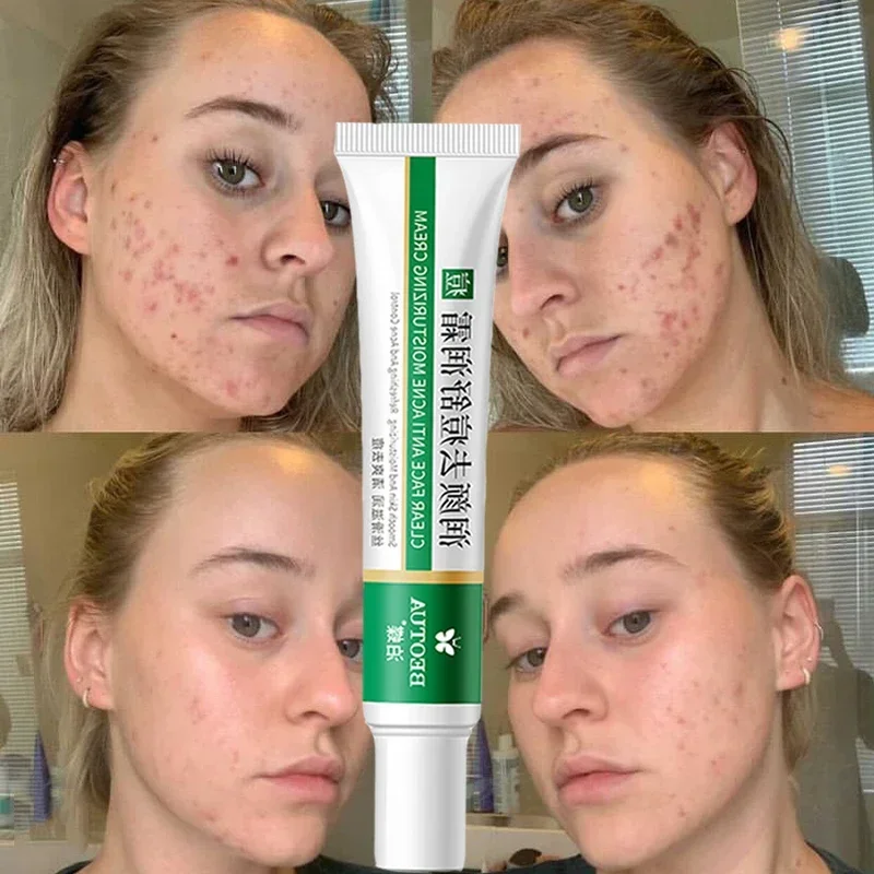 Best of Effective Acne Removal Cream Aloe Acne Spots Oil Control Anti-aging Moisturizing Whitening Acne Cream Treatment Skin Care 20g Reviews & Tips