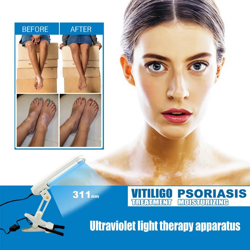 Best of Uvb 311nm Light Therapy For Vitiligo Psoriasis Eczema Dermatitis Skin Problems Treatment Uv Lamp 110V / 220V Reviews & Tips