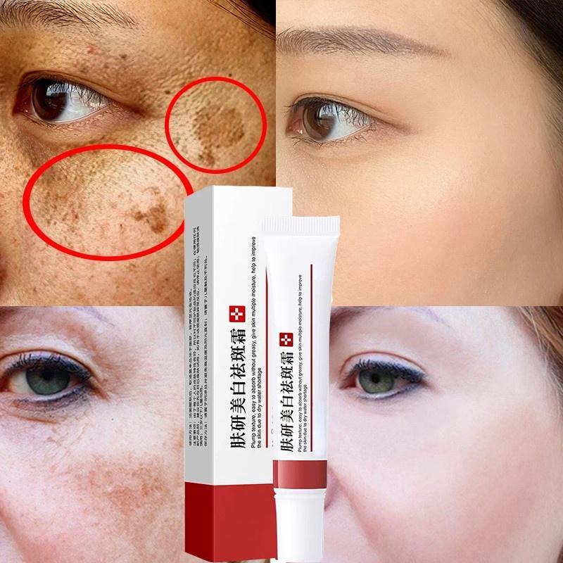 Best of Whitening Freckle Cream Effective Remove Dark Spots Anti Freckle Cream Fade Pigmentation Melasma Brighten Cream Reviews & Tips