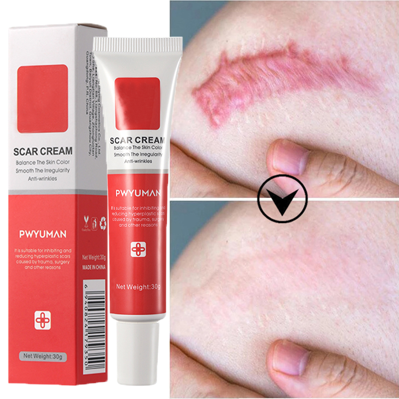 Best of Scar Stretch Marks Remover Cream Repair Burn Surgery Skin Treat Gel Keloids Acne Pox Prints Removal Ointment Smooth Skin Care Reviews & Tips