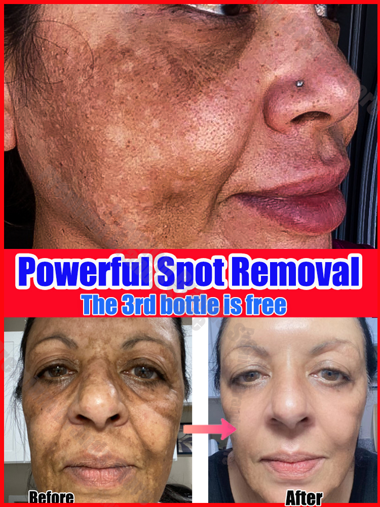 Best of Dark Spot Remover For Face Melasma Black Spots Cream Reviews & Tips