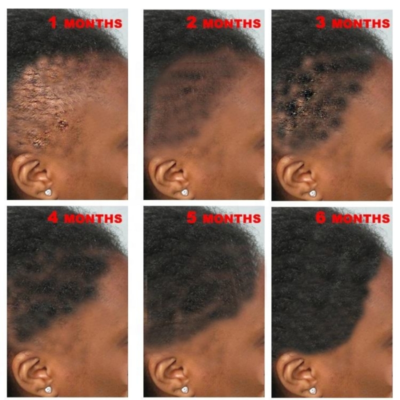 Best of Fast Hair Growth Serum African Natural Crazy Hair Regrowth Rosemary Oil Traction Alopecia Treatment Prevent Baldness Women Men Reviews & Tips - Image 4