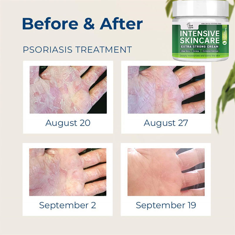 Natural Plant Extract Psoriasis Dermatitis Eczematoid Eczema Ointment Anti-Itch Chinese Herb Medical Skin Care Cream 15/30/50g