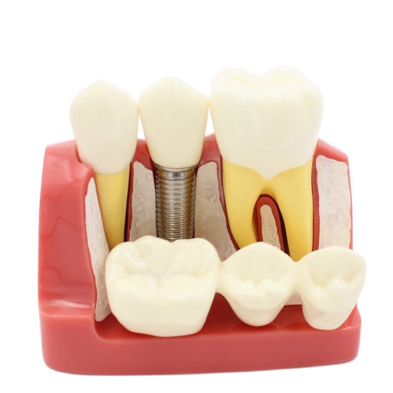 Best of Dental Teach Implant Analysis Crown Bridge Removable Model Dental Demonstration Teeth Model Reviews & Tips