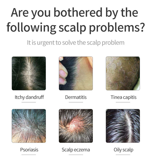 Dermatitis On Scalp