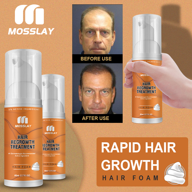 Best of Mosslay Hair Growth Foam, 5% Active Ingredients, Prevent Hair Loss, Repair Hair Follicles And Help Hair Regrowth Reviews & Tips