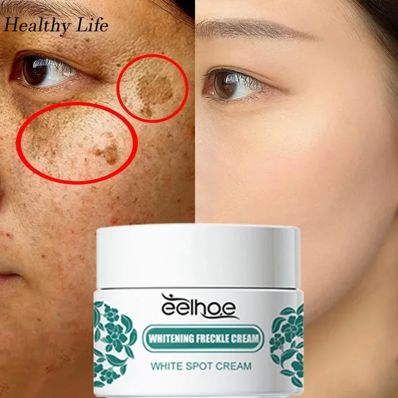 Best of Niacinamide Remove Spot Whitening Cream Fade Pigmentation Freckle Cream Reduces Dark Spots Melasma Serum Anti-aging Face Care Reviews & Tips