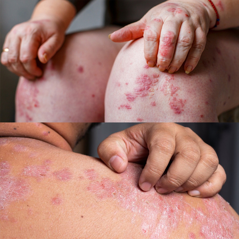 Natural Plant Extract Psoriasis Dermatitis Eczematoid Eczema Ointment Anti-Itch Chinese Herb Medical Skin Care Cream 15/30/50g