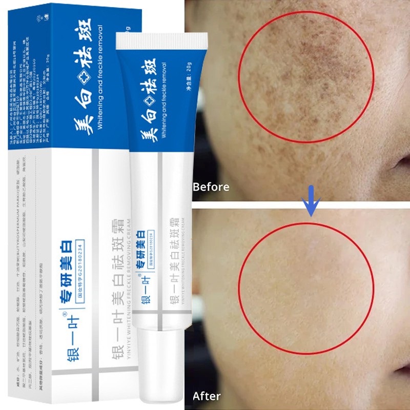 Best of Whitening Freckle Cream Effective Remove Melasma Dark Spots Cream Fade Melanin Moisturize Brighten Smooth Beauty Face Skin Care Reviews & Tips