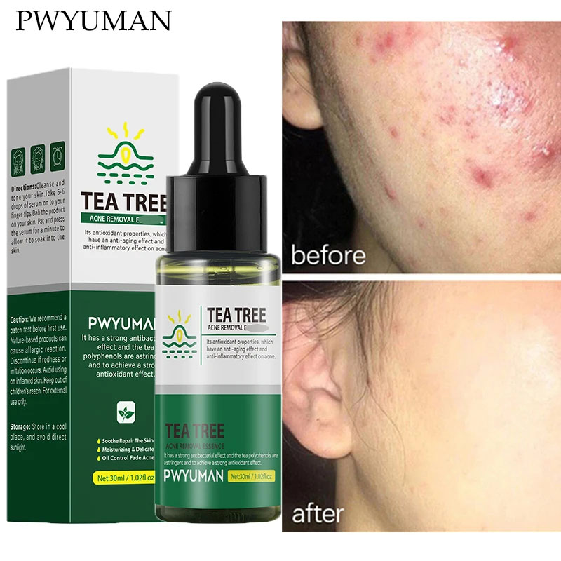 Best of PWYUMAN Tea Tree Acne Treatment Serum Effective Anti-acne Repair Pimples Spots Scar Pore Shrinking Oil Control Moisturizing Care Reviews & Tips