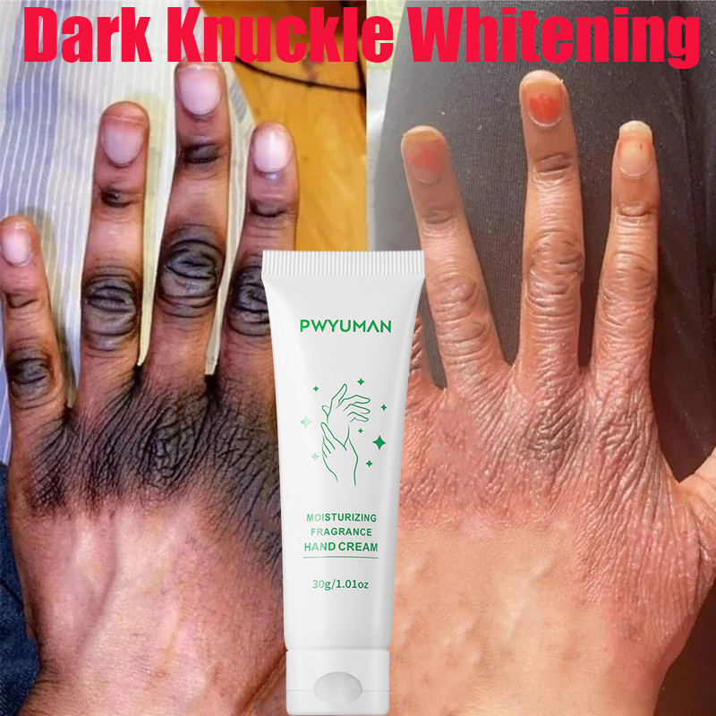 Best of Dark Knuckles Fast Whitening Serum Anti Cracking Cream Pigmentation Correctors For Black Skin Intense Stains Remover Products Reviews & Tips