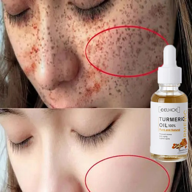 Best of 10PCS Whitening Freckle Serum Brighten Remove Dark Spot Fade Pigment Melanin Correcting Facial Essence Skin Care Korea Comestic Reviews & Tips