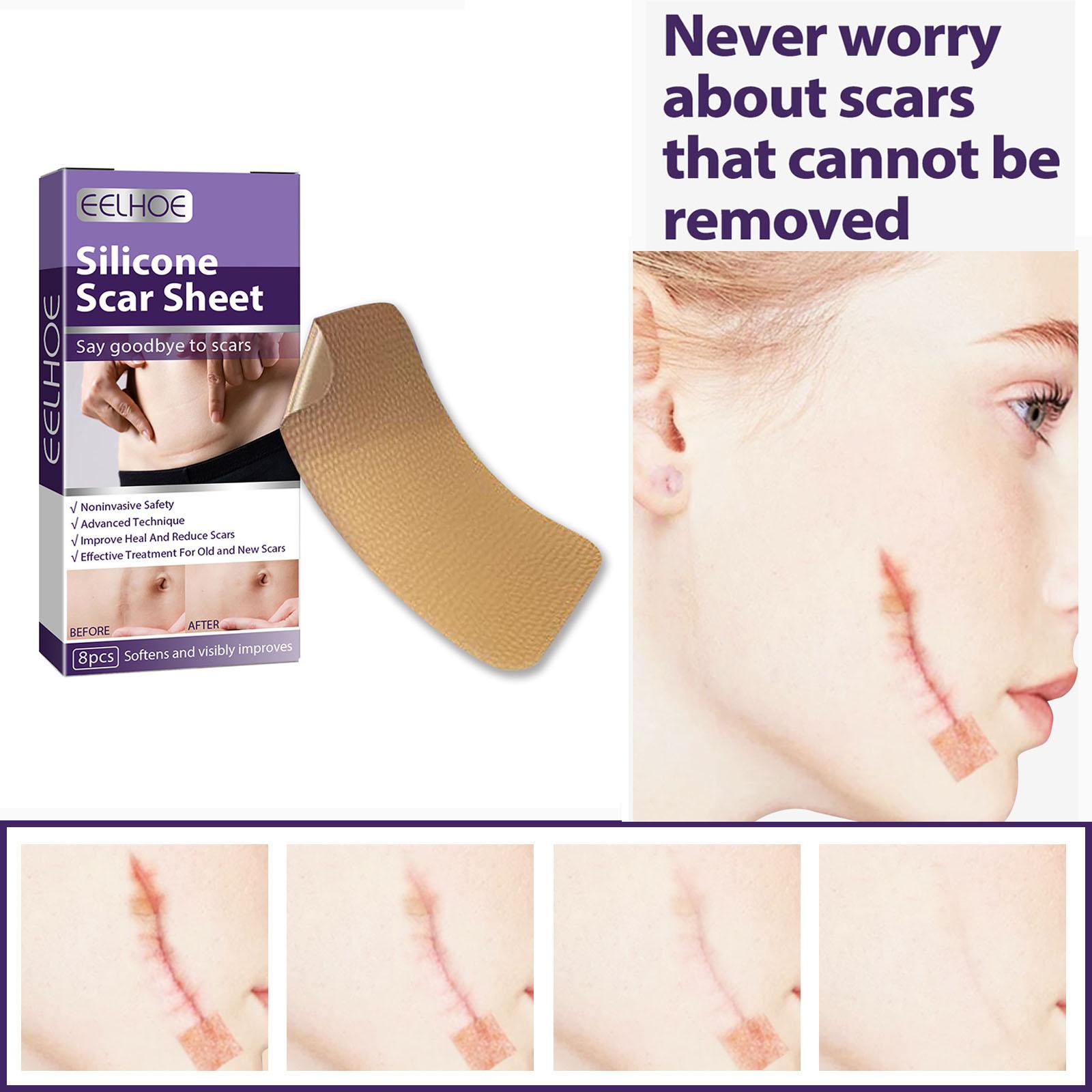 Scar Removal Silicone Scar Strips, for Burn Scars Acne Scars Keloid Scars Soft Scar Patch Comfortable Stretch Mark Reducer