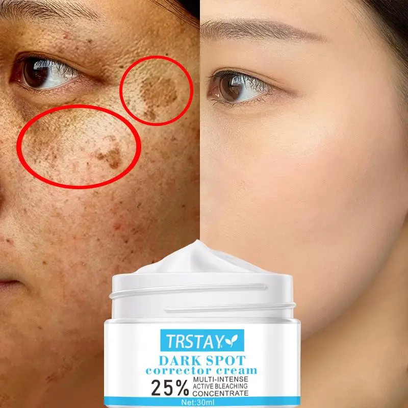 Best of Whitening Freckles Cream Remove Melasma Dark Spots Lighten Melanin Melasma Remover Moisturizing Brighten Face Skin Care TRSTAY Reviews & Tips