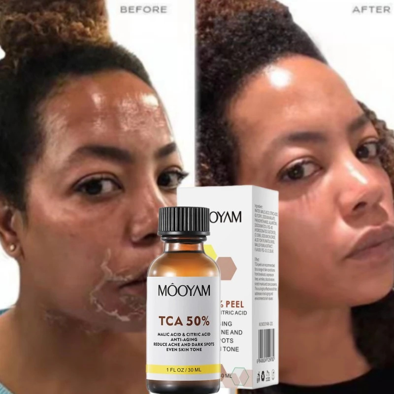 Best of High Quality TCA 50% Chemical Peel Tca Peel Acid Skin Superforce Peel Pigmentation Lightening Melanin Acne Treatment Remove Scar Reviews & Tips