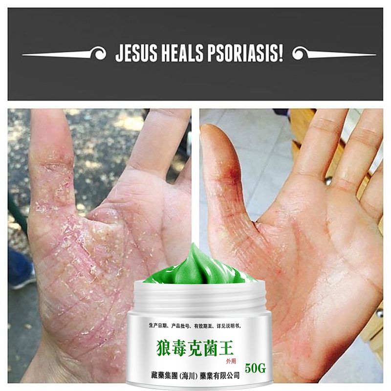 50g Psoriasis Dermatitis Eczematoid Eczema Ointment Anti-Itch Chinese Herb Medical Skin Care Cream