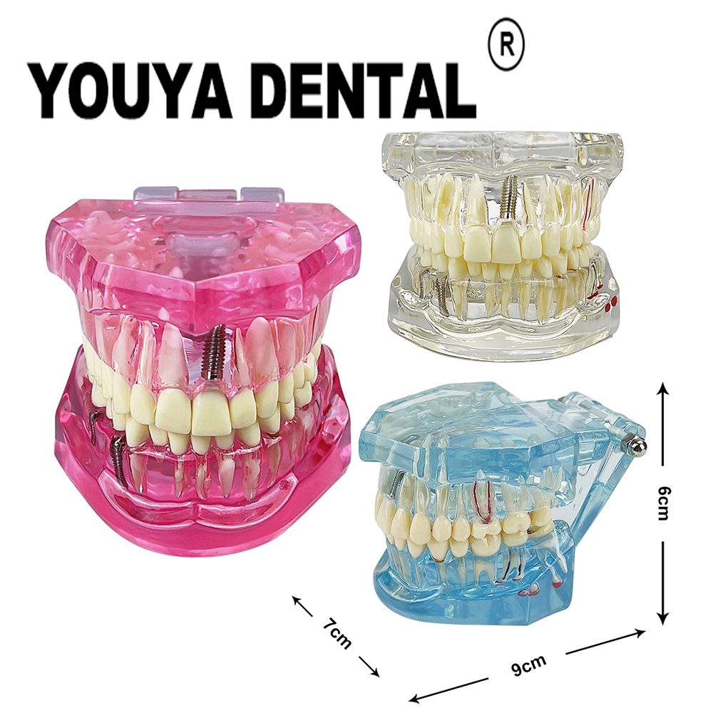 Best of Teeth Repair Model Disease Teeth Model For Dentist Student Practice Training Studying Oral Medical Dentistry Tools Reviews & Tips