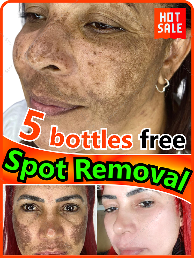 Best of Spot Removal Chloasma Light Dark Reviews & Tips