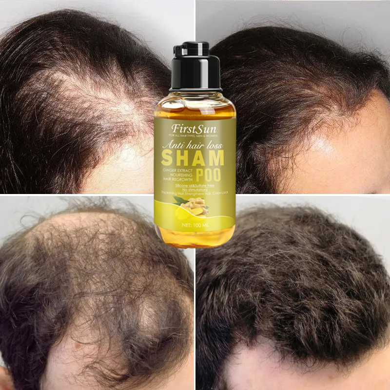 Best of Unisex Anti Hair Loss Ginger Shampoo Hair Growth Products Shampoo Against Hair Loss Mild Treatment Ginger Shampoo For Hair Loss Reviews & Tips