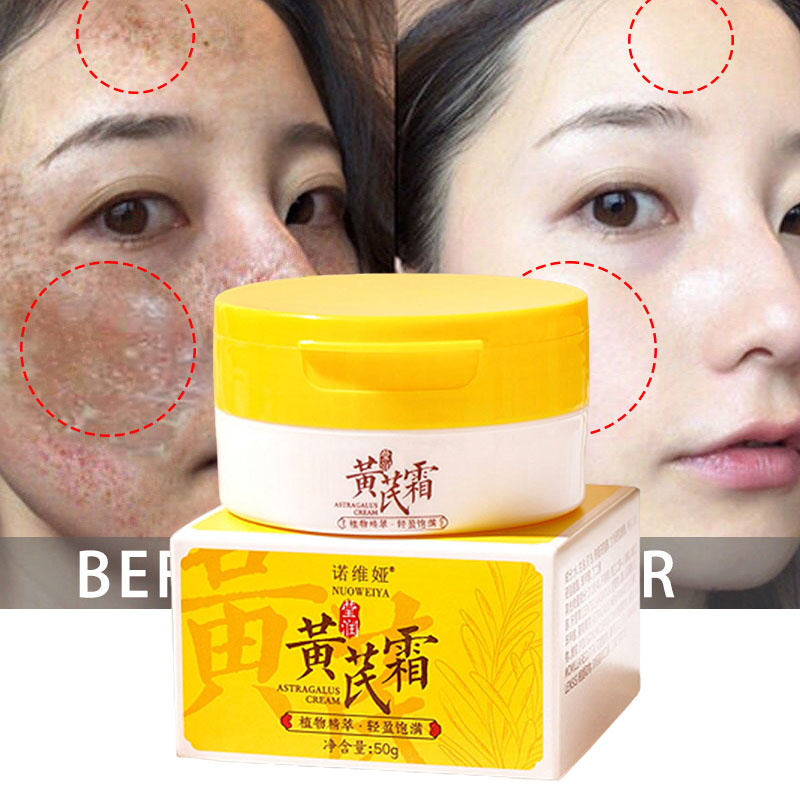 Best of Astragalus Whitening Freckle Face Cream Effective Remove Dark Spots Fade Melasma Melanin Moisturizing Brighten Dull Skin Care Reviews & Tips