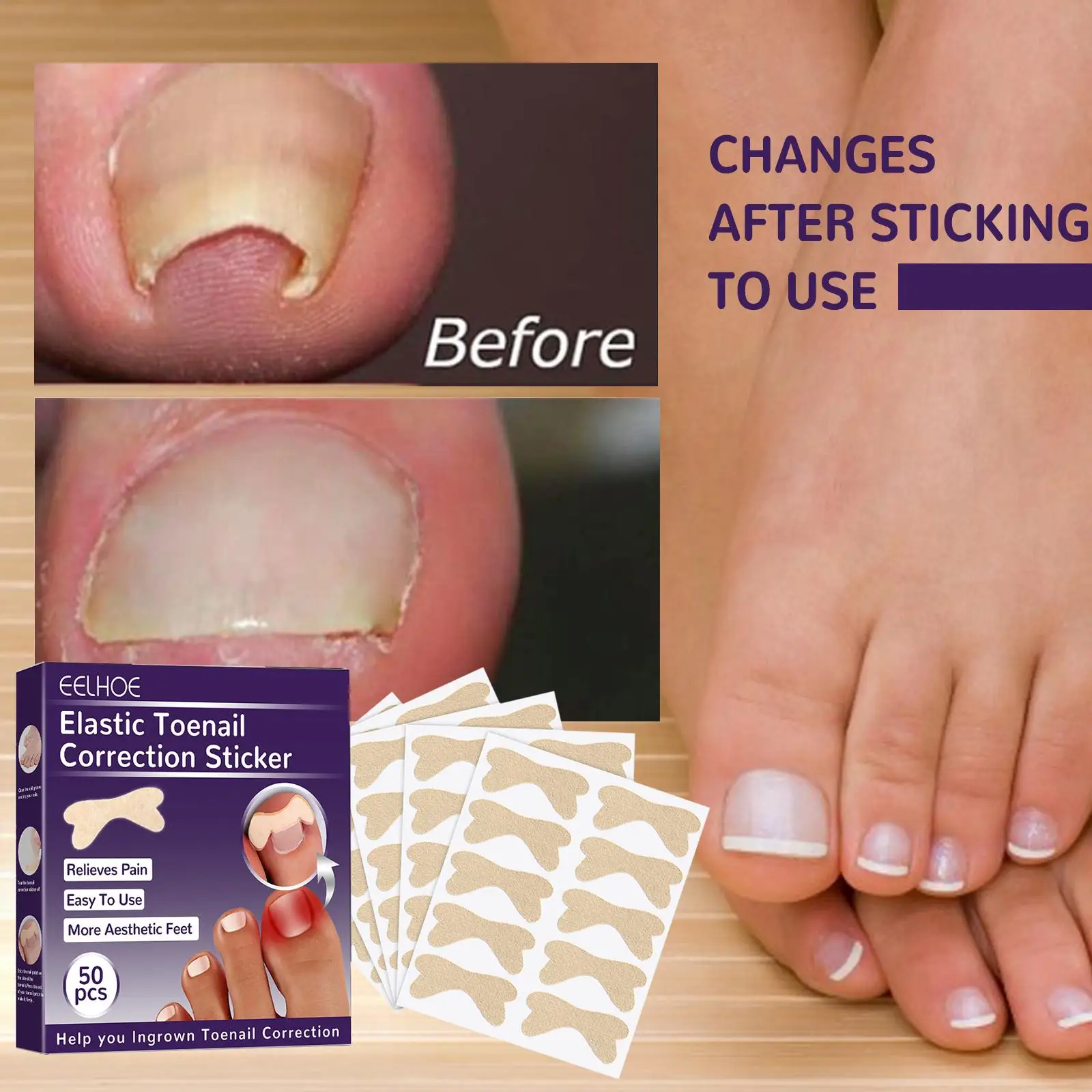 50x Toenail Corrector Patch Glue Free Pedicure Tools Ingrown Toenail Correction Stickers Toenail Corrector Patches for Toe Nail