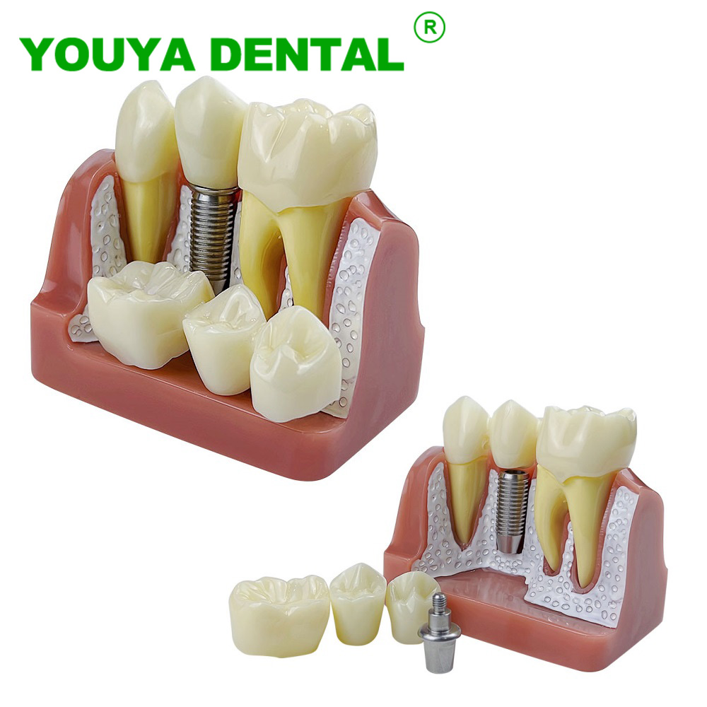 Best of Dental Implant Teeth Model 4 Times Dentistry Teach Implant Analysis Crown Bridge Removable Model Dentist Demonstration Tool Reviews & Tips