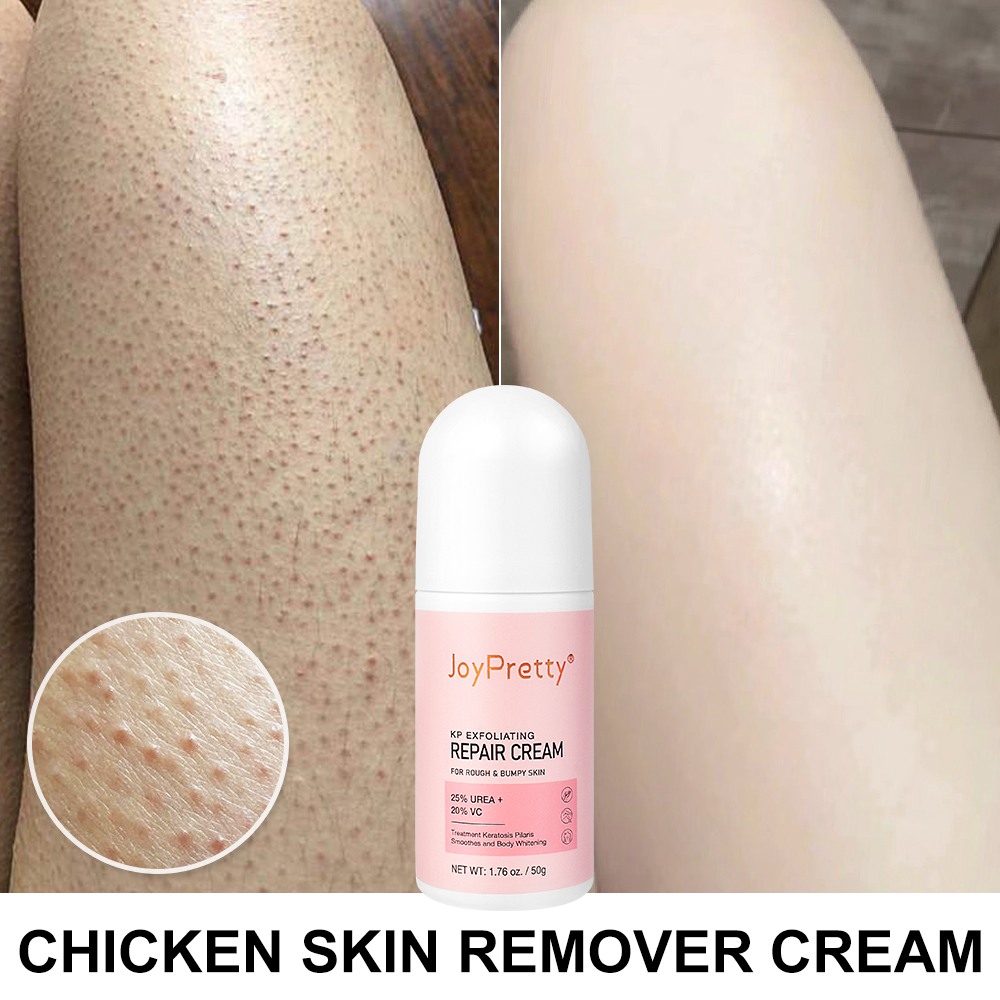 Best of Body Cream Chicken Skin Removal Treatment Keratosis Pilaris Lotion Rough Bumpy Pore Spots Care Moisturizer Whitening Creams 60g Reviews & Tips