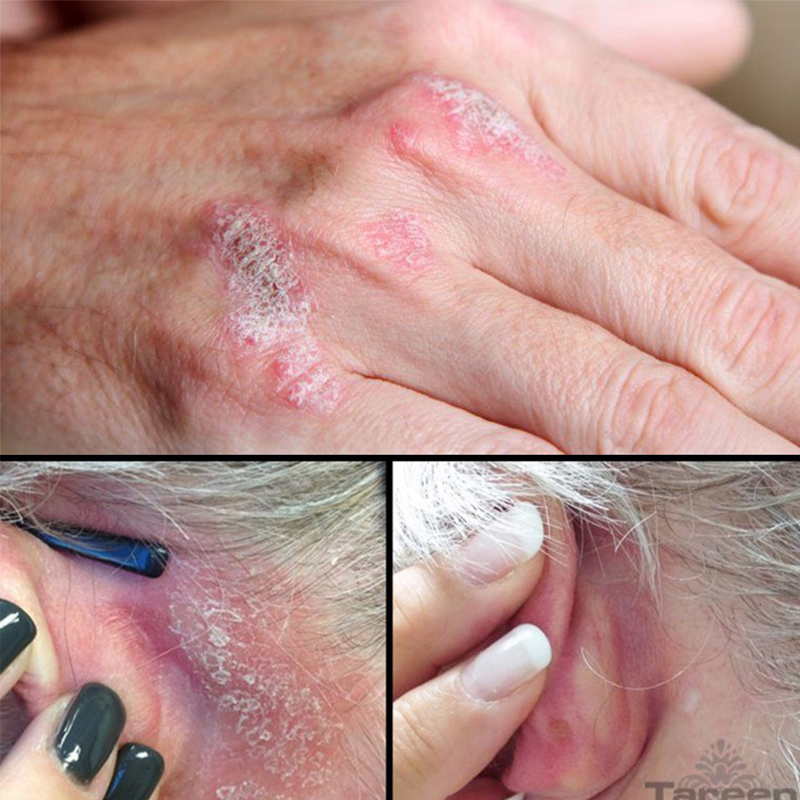 Natural Plant Extract Psoriasis Dermatitis Eczematoid Eczema Ointment Anti-Itch Chinese Herb Medical Skin Care Cream 15/30/50g