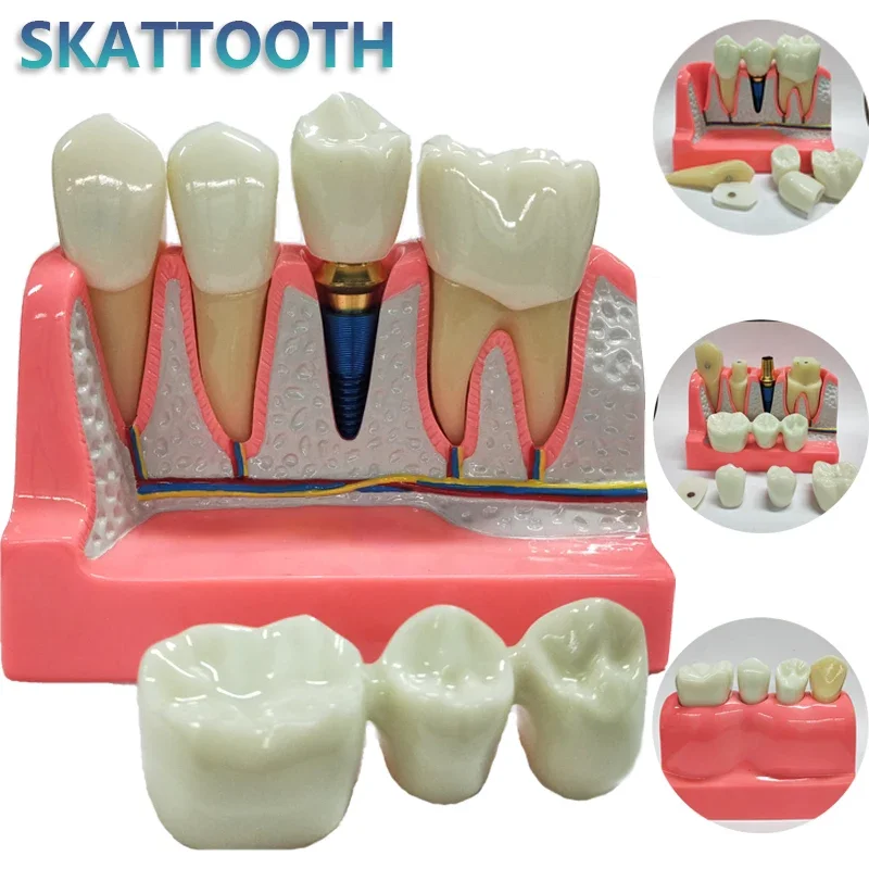 Best of New Dental Implant Teach Crown Bridge Removable Model Porcelain Teeth Model Dental Demonstration Model For Dentist Teaching Reviews & Tips