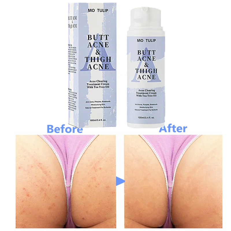 Best of 100ml Butt Acne Clearing Spot Treatment Cream Clears Acne Pimples Zits Razor Bumps And Dark Spots For The Buttocks Thigh Area Reviews & Tips