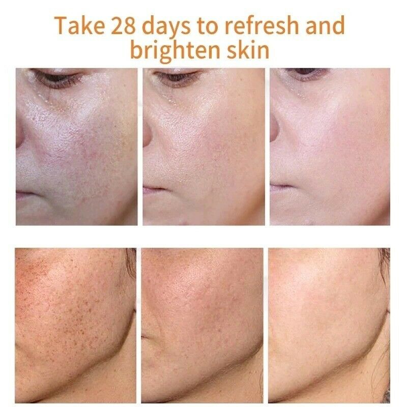 Best of Skin Face Whitening Freckle Cream Remove Melasma Acne Pigment Melanin Dark Spots Anti Freckle Cream Fade Pigmentation Brighten Reviews & Tips - Image 2