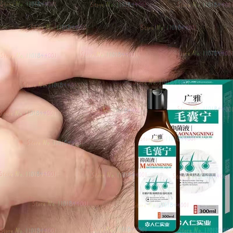 Best of Scalp Soothing Mites Maoyan Nangning Shampoo Wholesale Anti-dandruff Anti-itching Shampoo Scalp Ringworm Shampoo Repair Damage Reviews & Tips