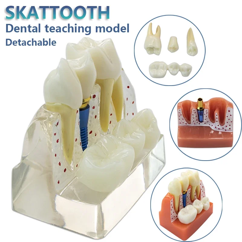 Best of Dental Implant Model Crown Bridge Model Detachable Dental Model For Dental Teaching Dentist Training Dental Demonstration Model Reviews & Tips