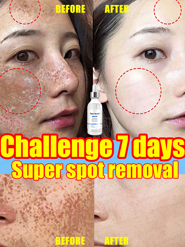 Best of Quickly Freckle Removal Improve Freckle Dark Spots Sun Melasma Remove Age Spots Lightening Melanin Whitening Facial Skin Care Reviews & Tips