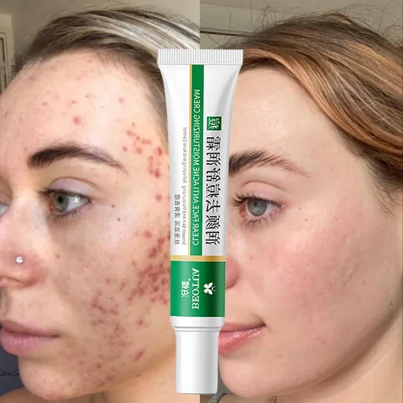 Best of Effective Acne Removal Cream Aloe Acne Spots Oil Control Anti-aging Moisturizing Whitening Acne Cream Treatment Skin Care 20g Reviews & Tips - Image 2