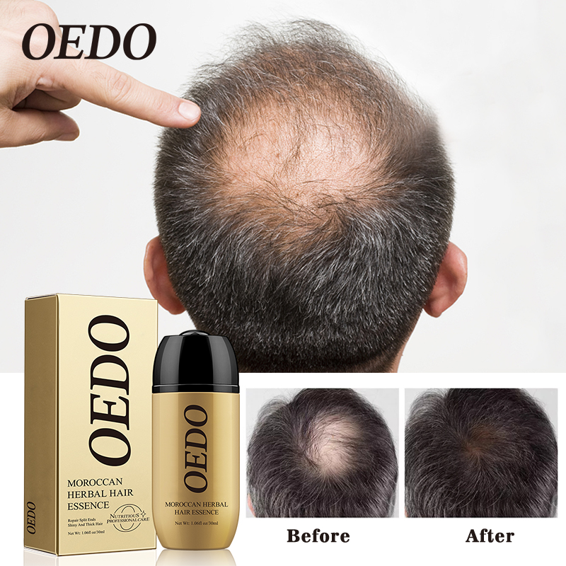 Best of OEDO Morocco Herbal Hair Care Essence Oil For Hair Hair Treatment Fast Grow Repair Scalp Beauty Hair Prevent Hair Loss Oil Reviews & Tips