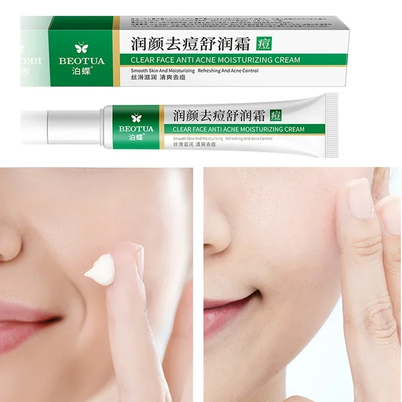 Best of Effective Acne Removal Cream Aloe Acne Spots Oil Control Anti-aging Moisturizing Whitening Acne Cream Treatment Skin Care 20g Reviews & Tips - Image 4