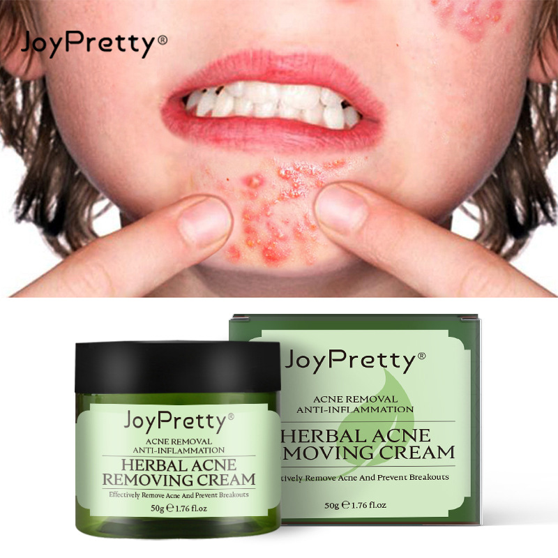 Best of JoyPretty Herbal Acne Removal Face Cream Against Pimple Remover Ance Treatment Anti Ance Moisturizing Repair Damage Skin Care Reviews & Tips